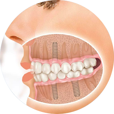 Implantology Instruments 